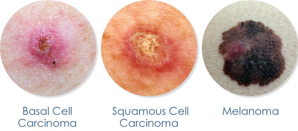 Type of Skin Cancer: Basal Cell Carcinoma, Squamous Cell Carcinoma, Melanoma
