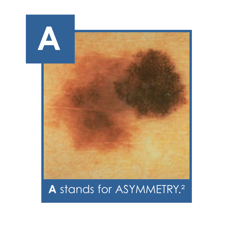Asymmetry - - the 1st sign of skin cancer to look for