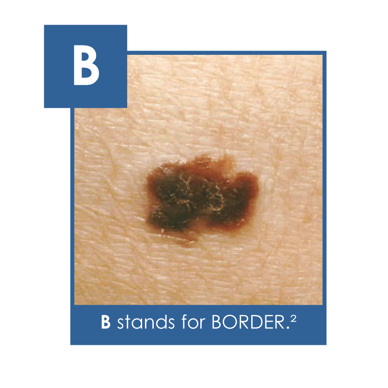 Border - an uneven border is the 2nd sign of skin cancer to look for