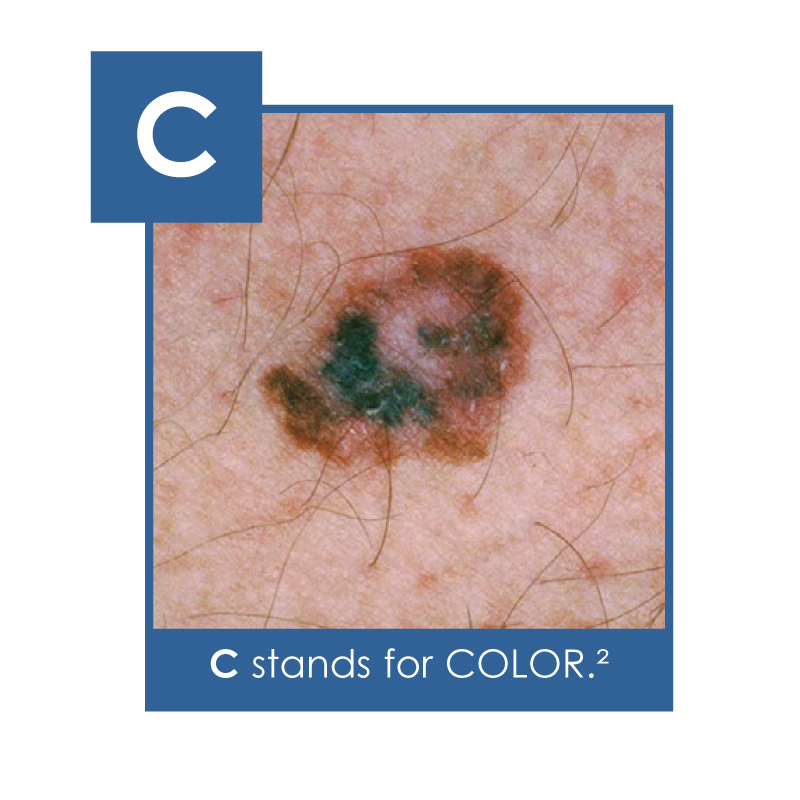 Color - uneven or unusual color - the 3rd sign of skin cancer to look for