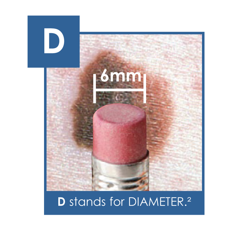 Diameter - an increasing or changing diameter - the 4th sign of skin cancer to look for