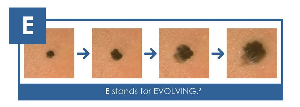 Evolving - the 5th sign of skin cancer to look for