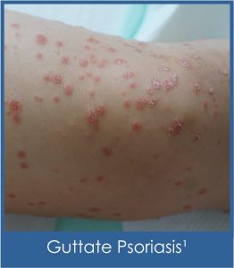 Guttate Psoriasis closeup on knee