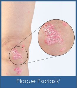 Plaque psoriasis close-up on knee