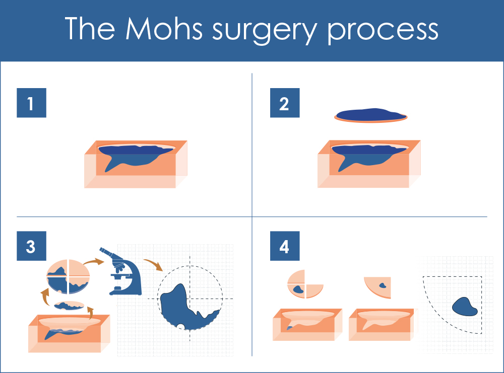 Illustration of the steps followed for Mohs surgery for skin cancer