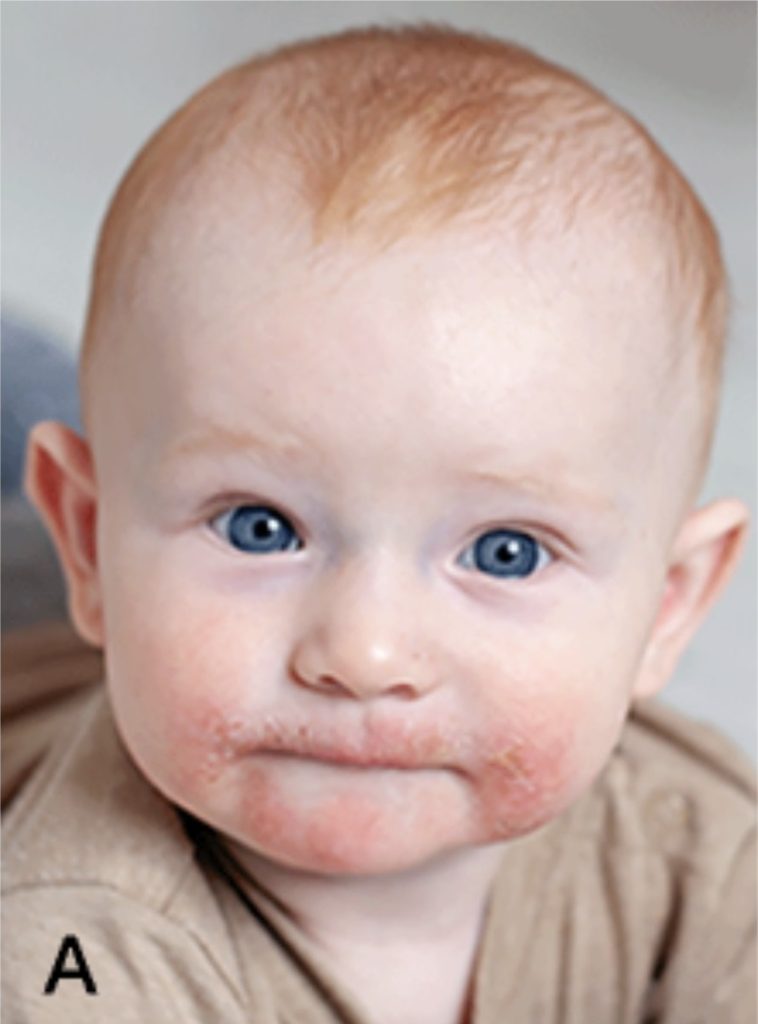 Baby with atopic dermatitis around his mouth