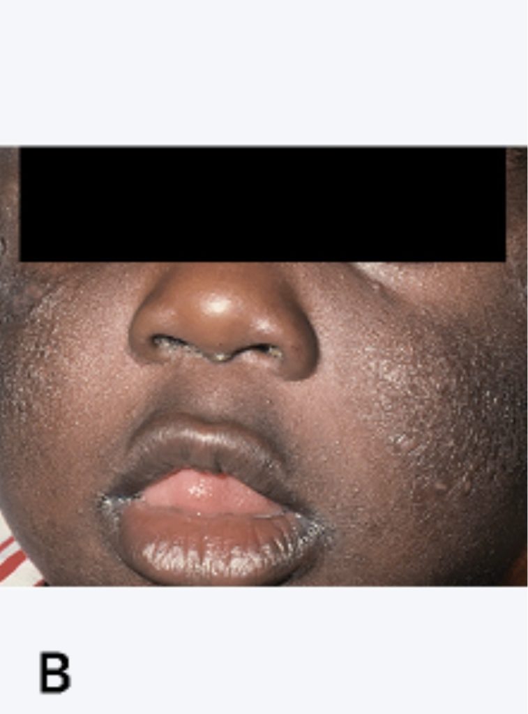 Baby with atopic dermatitis on his cheeks