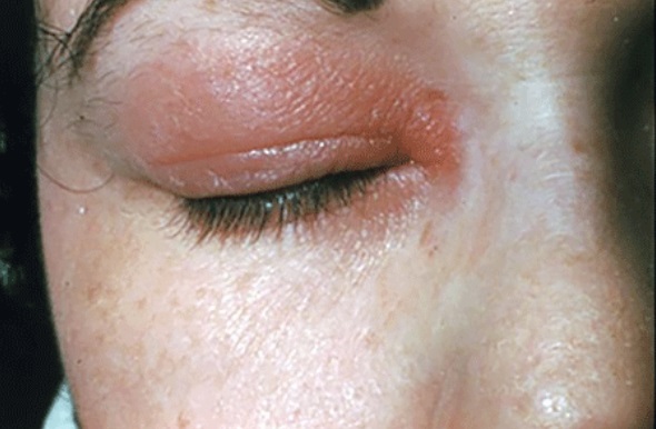 Adult with contact dermatitis on their eyelids