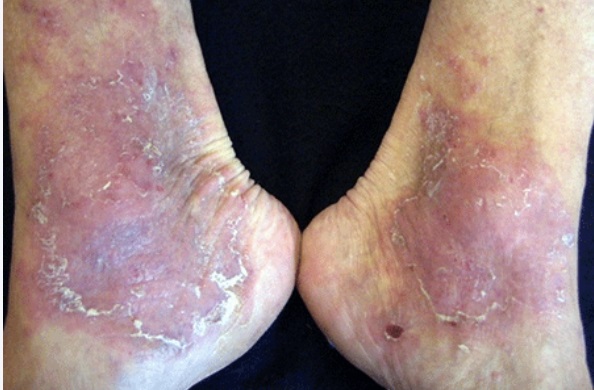 Adult with stasis dermatitis on their feet and ankles