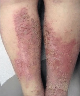 Adult with stasis dermatitis on their legs