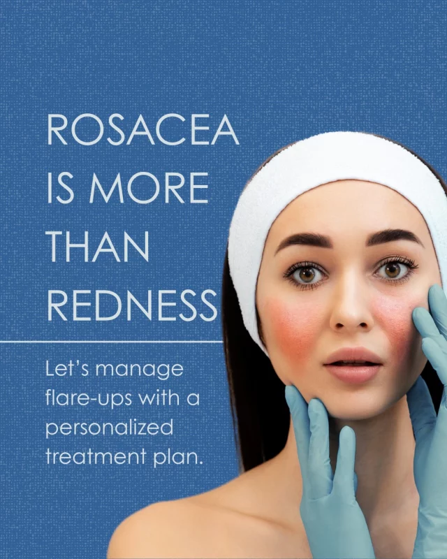 Rosacea affects millions of Americans—but many go undiagnosed or untreated.
Our dermatologists offer solutions that target the root cause of redness, inflammation, and visible blood vessels. You don’t have to live with flare-ups.
Let’s build a plan together.

#medicalskincare #derm #skincare #laser #antiaging #cosmetics #diagnostics #acnetreatment