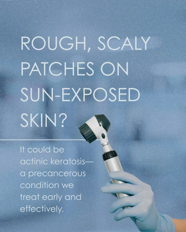 Actinic keratosis often shows up as rough, dry, or scaly patches on areas frequently exposed to the sun.

These spots can develop into skin cancer if left untreated. The good news? They’re highly treatable when caught early.

Ask us about your skin concerns—we’re here to help.

 #sundamage #sunprotection #sun #dermatology #dermatologist #derm #awerness #dermatology