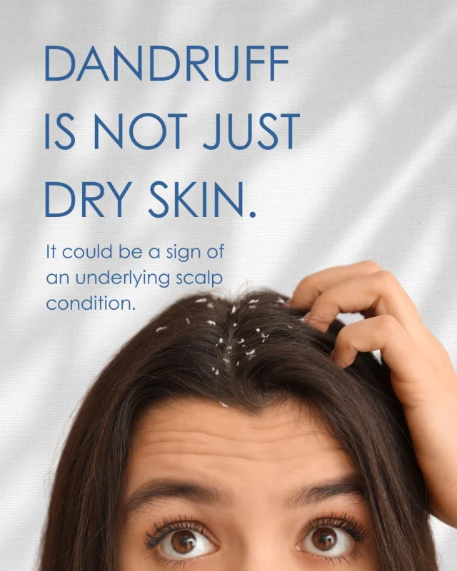 Flakes, itching, and inflammation could be caused by more than dry weather.

We diagnose and treat scalp conditions like seborrheic dermatitis, psoriasis, and fungal infections.

Healthy hair starts with a healthy scalp.

 #scalptreatment #healthyscalp #scalp #selfcare #haircaretips #antidandruff #healthandwellness #alopecia