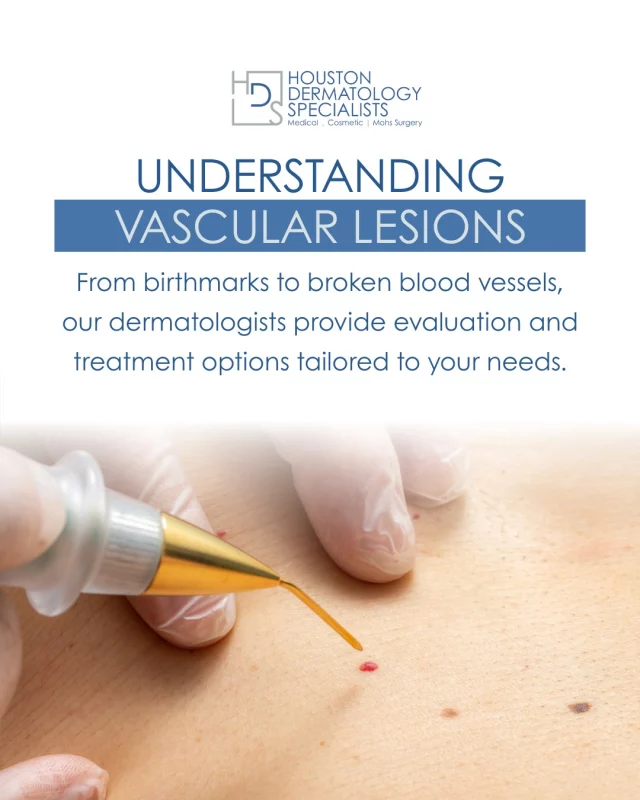 Vascular lesions are common and may appear as red or purple marks on the skin. They can include birthmarks, spider veins, or broken blood vessels.

While many vascular lesions are harmless, some can affect confidence or require treatment. Our dermatologists provide professional evaluations and safe, effective options to address both medical concerns and cosmetic appearance.

If you have questions about a skin spot or mark, we are here to help.

#dermatology #selfcare #warts #sensitiveskin #skinhealth
