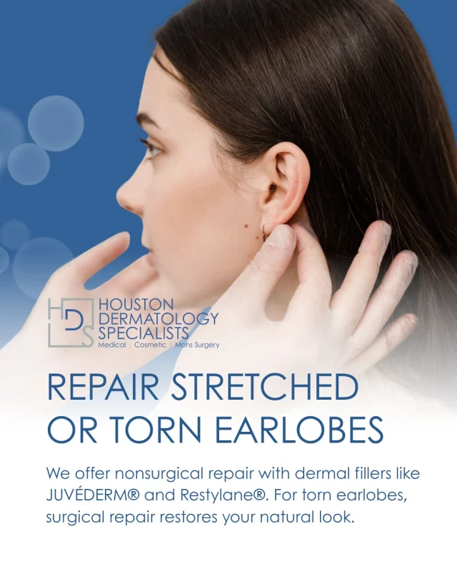 Stretched or torn earlobes from heavy earrings or piercings can be easily repaired with our expert treatments. Houston Dermatology Specialists offers both nonsurgical repair using dermal fillers like JUVÉDERM® and Restylane® and surgical solutions for more severe cases. Our goal is to restore your earlobes to their natural, youthful appearance with a customized treatment plan that fits your needs.

🌟 Book an appointment today: link in bio.

#houstondermatologyspecialists #earloberepair #tornearlobe #juvederm #restylane #cosmeticdermatology #noninvasivetreatment #surgicalrepair #skincare #confidenceboost
