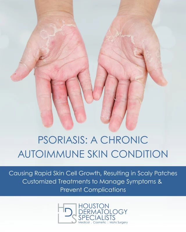 Psoriasis is a chronic autoimmune condition that speeds up the production of skin cells, leading to thick, scaly patches on the skin. Plaque psoriasis, the most common form, typically appears on the scalp, elbows, knees, and torso, but can affect any part of the body. Other types include guttate psoriasis, which creates small, drop-like lesions, and inverse psoriasis, which appears in skin folds.

If left untreated, psoriasis can progress into psoriatic arthritis, causing joint pain and stiffness. At Houston Dermatology Specialists, we offer a range of treatment options, from topical therapies and phototherapy to advanced biologic medications, all tailored to your specific condition. Early diagnosis and treatment are key to managing psoriasis and improving quality of life.

🌟 Learn more and schedule a consultation: link in bio.

#houstondermatologyspecialists #psoriasiseducation #psoriasisawareness #skinhealth #autoimmunecondition #dermatologycare #psoriasisrelief #psoriaticarthritis #understandpsoriasis #healthyskin