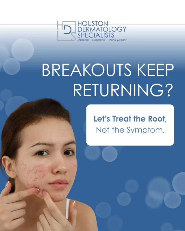 Recurring acne isn’t just frustrating, it’s a sign that your skin needs a targeted, medical approach. Over-the-counter products can calm things down, but they rarely solve what’s happening underneath.

Here’s how Houston Dermatology Specialists tackles acne at the source:
✔️ Prescription-strength treatments to calm inflammation and oil production
✔️ Medical-grade skincare to keep pores clear
✔️ Chemical peels for active breakouts + discoloration
✔️ SkinPen® Microneedling to soften texture and acne scars
✔️ LUCENT IPL or CO2RE® laser for stubborn pigmentation

When the treatment matches the cause, the acne cycle finally breaks.
Your clear-skin plan starts with the right diagnosis.

✨ Book your acne evaluation: www.houstondermatologyspecialists.com or link in bio!

#houstondermatologyspecialists #acnesolutions #clearskinplan #dermatologycare #acnetreatment #skinrenewal #microneedlingacne #laserforskin #breakoutcontrol #healthyskinjourney