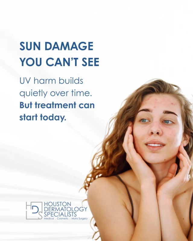 Most sun damage isn’t visible right away, it builds slowly beneath the skin. Years of UV exposure can create hidden changes that eventually appear as:

✔️ Dark spots & pigmentation
✔️ Uneven skin tone
✔️ Rough texture
✔️ Fine lines
✔️ Early aging

The good news? You can treat the damage, even if it’s been years.
At Houston Dermatology Specialists, our dermatologists use advanced technology like:

✨ LUCENT IPL: targets pigmentation, redness, sun spots
✨ CO2RE® Laser: resurfaces damaged skin + boosts collagen

These treatments help reverse visible and underlying sun damage for clearer, healthier-looking skin.

Ready to undo what the sun has done?
Book your consultation today: www.houstondermatologyspecialists.com or link in bio!

#houstondermatologyspecialists #sundamage #uvdamage #laserskintreatment #ipltherapy #skincareeducation #pigmentationtreatment #dermatologyexperts #healthyskinjourney #glowwithconfidence