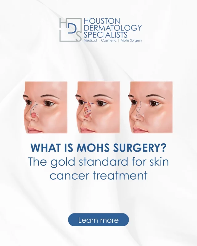 Mohs Micrographic Surgery is one of the most precise and effective treatments for certain types of skin cancer.

This specialized technique removes cancerous skin layer by layer, examining each layer under a microscope in real time. By doing so, Mohs surgery:
✔️ Preserves as much healthy skin as possible
✔️ Offers the highest cure rates for many skin cancers
✔️ Is especially effective for cancers on the face, ears, nose, and hands
✔️ Allows for immediate confirmation that cancer has been fully removed

At Houston Dermatology Specialists, Mohs surgery is performed by fellowship-trained, double board-certified dermatologist Christopher Downing, M.D., FAAD, ensuring both medical precision and thoughtful cosmetic outcomes.

When it comes to skin cancer treatment, experience and expertise matter.

✨ Schedule a consultation to learn more:
www.houstondermatologyspecialists.com or link in bio.

#houstondermatologyspecialists #mohssurgery #skincancertreatment #medicaldermatology #dermatologyexperts #earlydetection #houstonskincare #patienteducation #healthyskinjourney #trustedcare